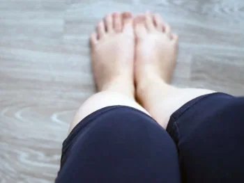 Existe dieta para lipedema?